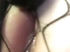 Anal bead removal